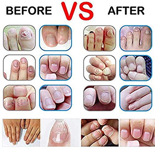  DTDR Euconychia Herbal Nail Treatment Pen Nail Repair Fingernails Toenails Rich Nutrition（2pcs)