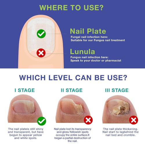  Dr. Luke Finger Nail And Toe Nail Fungus Treatment Extra Strength, Fungal Nail Renewal, Fungus Nail Treatment, Fungi Nail Repair For Nail antifungal