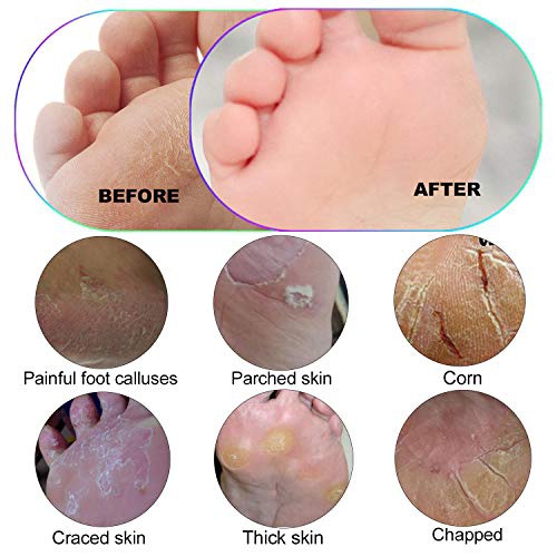  Foot Scrubber Callus Remover for Feet - Ejiubas Foot Scraper Pedicure Foot File Colossal Foot Rasp for Dead Skin Grater Heel File for Wet and Dry Feet