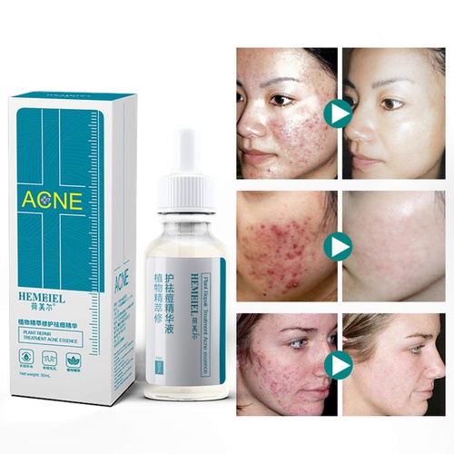  HEMEIEL Acne Serum Anti Acne and Scar Face Essence Cream, Natural Skin Treatment Essence Fast Repair, Organic Active Ingredients 30ml