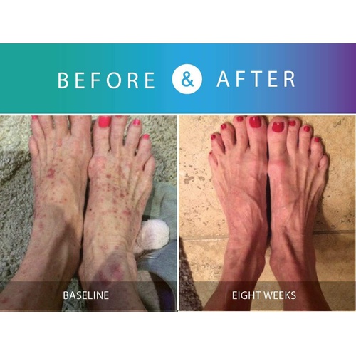  Prosoria (60 Day) Psoriasis Treatment System with Clinical Strength and Natural Botanical Ingredients - Treating Softening and Restoring the Appearance of Skin