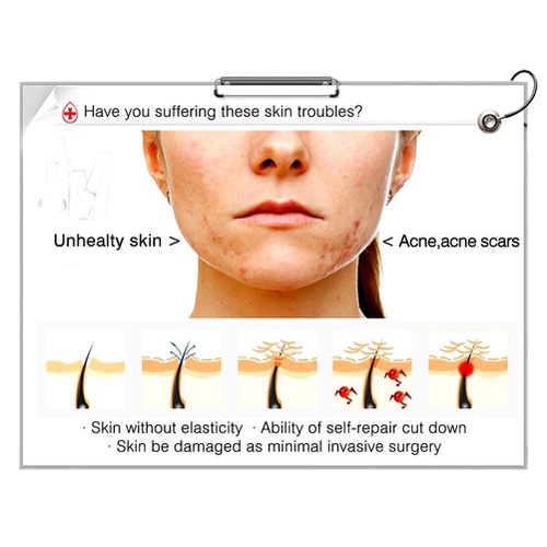  Anti-Pimple Essence, SUNSENT Rejuvenation Serum For Face Dermal Scar Acne Repair Freckle Blemish Anti-wrinkle Skin Care (5 Pairs)