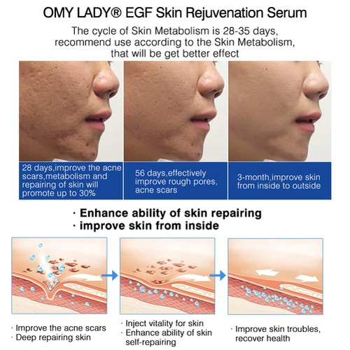  Anti-Pimple Essence, SUNSENT Rejuvenation Serum For Face Dermal Scar Acne Repair Freckle Blemish Anti-wrinkle Skin Care (5 Pairs)