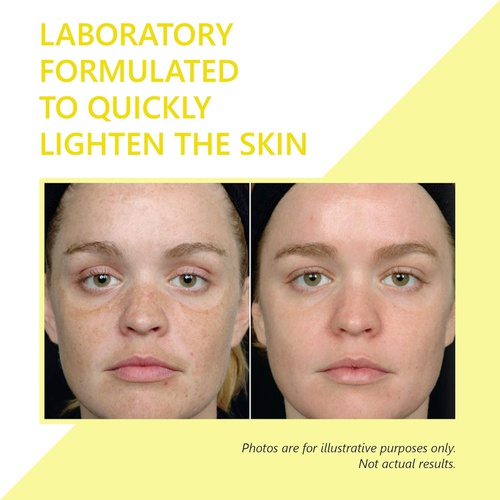  Hydroquinone Skin Lightener & Dark Spot Corrector - SkinPro Medical Grade Skin Care, Fades Uneven Skin Tone and Spots, Skin Lightening Cream for Face and Body