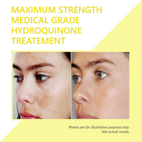  Hydroquinone Skin Lightener & Dark Spot Corrector - SkinPro Medical Grade Skin Care, Fades Uneven Skin Tone and Spots, Skin Lightening Cream for Face and Body