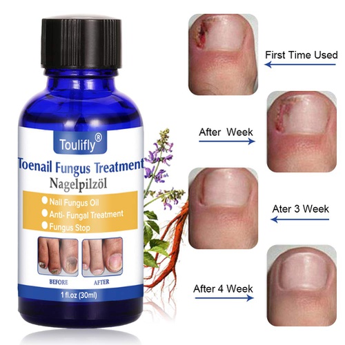  Cherioll Nail Repair, Natural Nail Treatment, Maximum Strength Nail Solution, Maximum Strength Fungal Toenail Solution