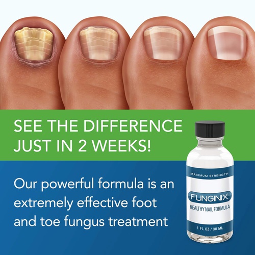  FUNGINIX Finger and Toe Treatment - Maximum Strength Solution, Eliminate Infections, Powerful & Effective (1 Fluid Ounce)