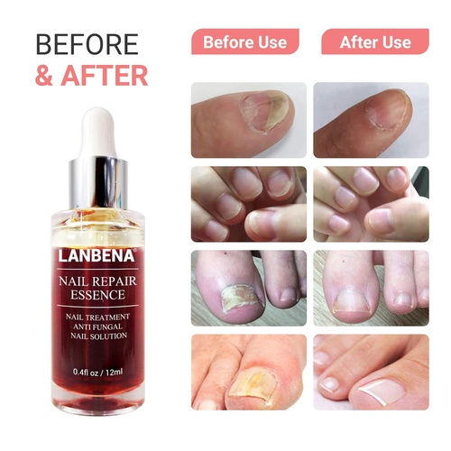  LANBENA Nail Repair Essence, Nails Repair Essence Nail Repair for Damaged Nails Protect Nail from Damage Fingernail and Toenail Repair for Curing Nail from Infection Discolored & D