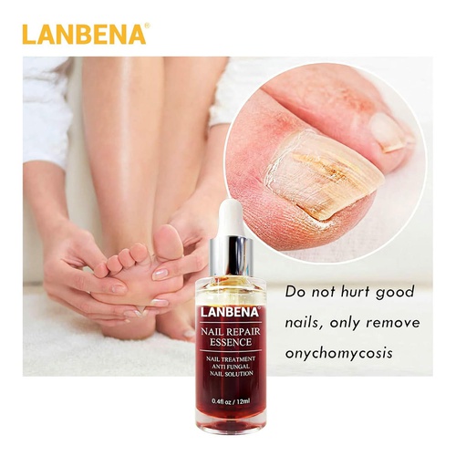  LANBENA Nail Repair Essence, Nails Repair Essence Nail Repair for Damaged Nails Protect Nail from Damage Fingernail and Toenail Repair for Curing Nail from Infection Discolored & D