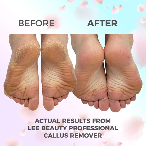  Lee Beauty Professional 8oz Callus Remover gel for feet for a professional pedicure. Better results than, foot file, pumice stone, foot scrubber, foot buckets & callus shaver. Rid ugly callouses from feet