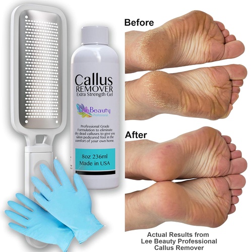  Lee Beauty Professional 8oz Callus Remover Gel and Foot File/Foot Rasp Spa Kit. Professional Foot Care for dry, cracked heels. Soak in foot spa then apply callus gel to feet, and use foot scraper to peel