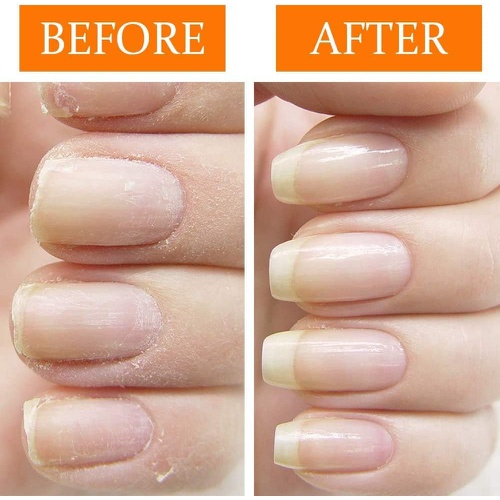  Nail Tek Nail Recovery Kit, Cuticle Oil, Strengthener, Ridge Filler - Restore Damaged Nails in 3 Steps