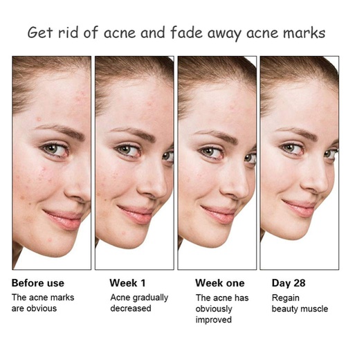  Onkessy Face Serum Fade Scar Essence,Moisturizing Oil Control Fades Acne Spots and Dark Spots Facial Serum Fits All Skin