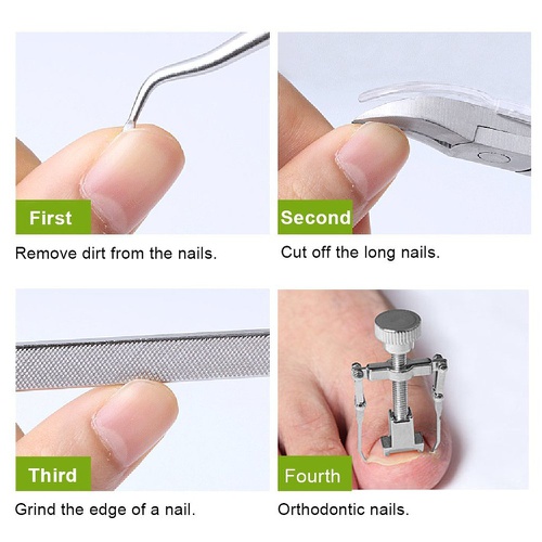  Pnrskter Ingrown toenail tool & Kit, Pedicure Tools, Professional Stainless Steel Ingrown Toe Nail Correction Tool, Nail File Clipper Lifter Corrector.