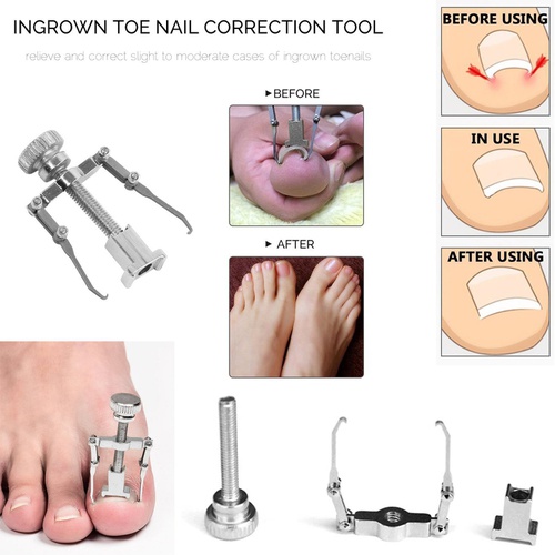  Pnrskter Ingrown toenail tool & Kit, Pedicure Tools, Professional Stainless Steel Ingrown Toe Nail Correction Tool, Nail File Clipper Lifter Corrector.