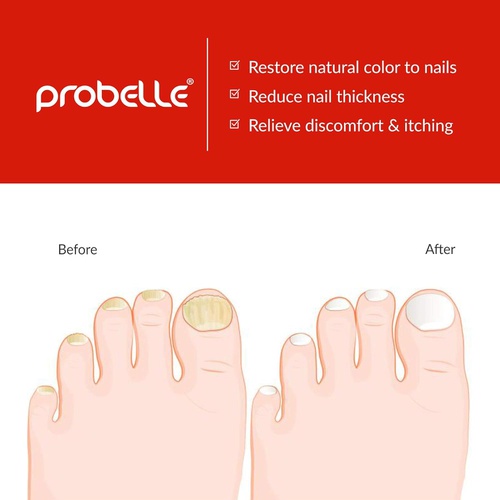  Probelle Natural Fungal Nail Treatment, Anti Fungal Nail Treatment, Nail Color Restoration, Clear Homeopathic Topical Solution .5 oz/ 15 ml (Patented Formula)