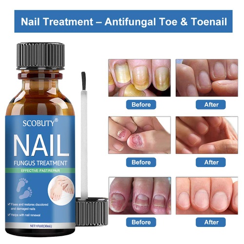  SCOBUTY Fungus Nail Treatment,Nail Fungus Treatment for Toenail,Nail Repair,Toe Fungus Nail Treatment Extra Strength,Fungal Toenail Care Solution for Damaged Nails